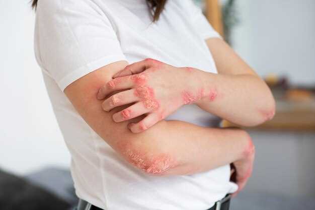 Common Symptoms of Psoriasis: